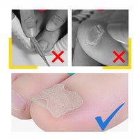 Thumbnail for Anti Paronychia Toe Relief Patches - 1 Sheet/10 Patches