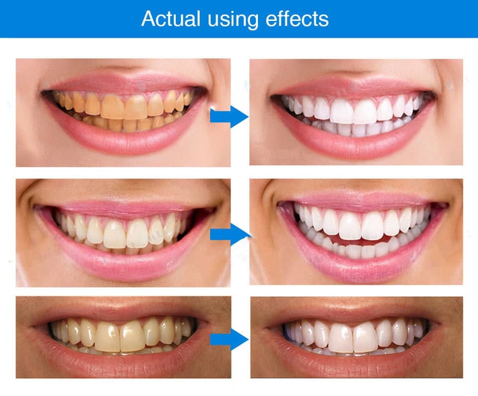 LANTHOME™ Teeth Whitening Essence (Buy 1 Get 1 Free)