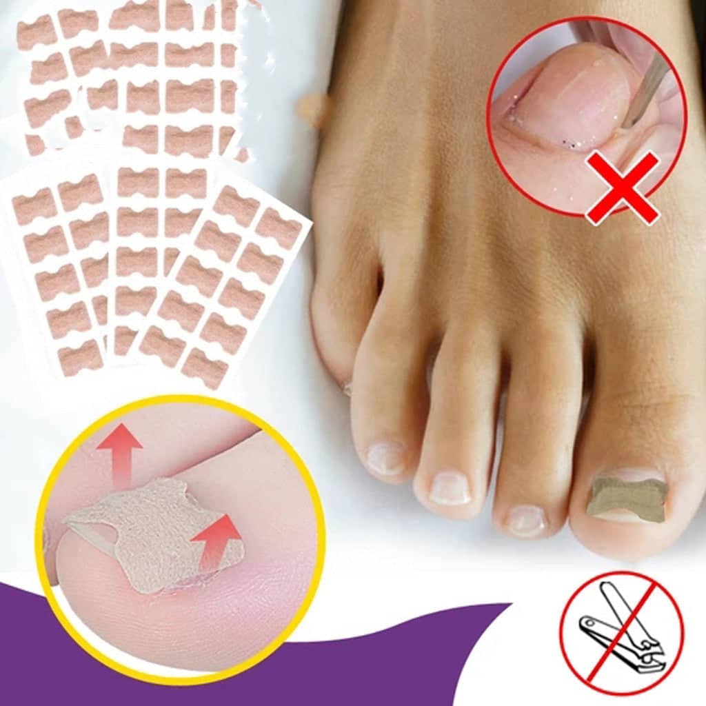Anti Paronychia Toe Relief Patches - 1 Sheet/10 Patches